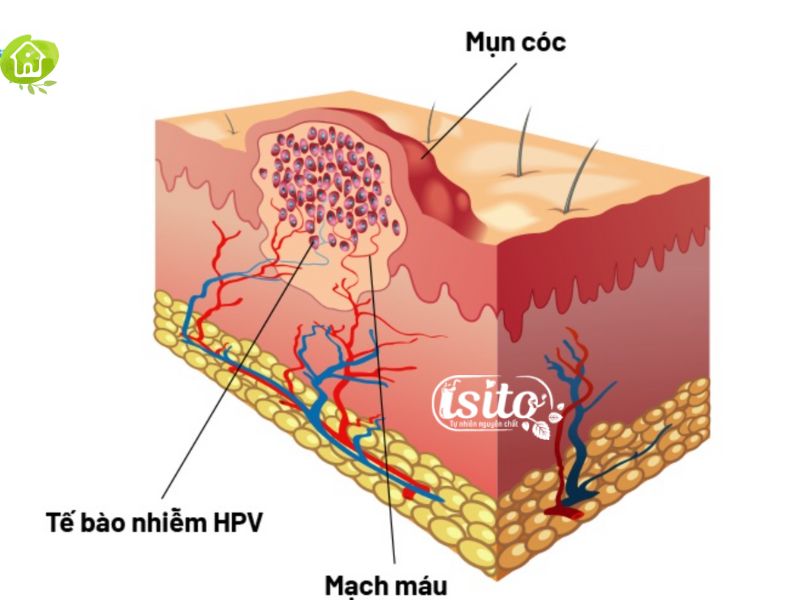 Mụn cóc, còn được gọi là mụn đốm, là một loại bệnh da phổ biến thường do virus HPV gây ra